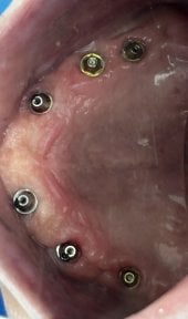 Dental implant placement result in upper jaw at Shanghai Y+bo Dental Clinic, visible abutments