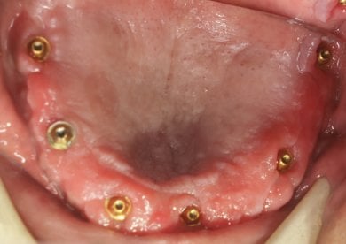 Dental implant placement result at Shanghai Y+bo Dental Clinic, visible implants in lower jaw