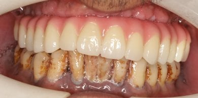 Dental implant result at Shanghai Y+bo Dental Clinic – restored upper teeth, natural look