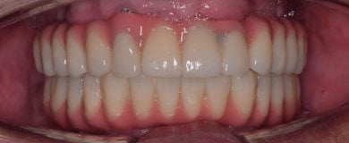 Full mouth dental implant result at Shanghai Y+bo Dental Clinic, restored natural-looking teeth