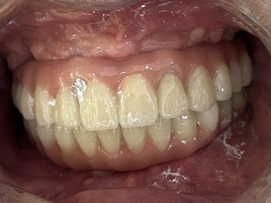 Dental implant result at Shanghai Y+bo Dental Clinic showing restored natural-looking teeth
