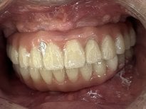 Dental implant result at Shanghai Y+bo Dental Clinic showing restored natural-looking teeth