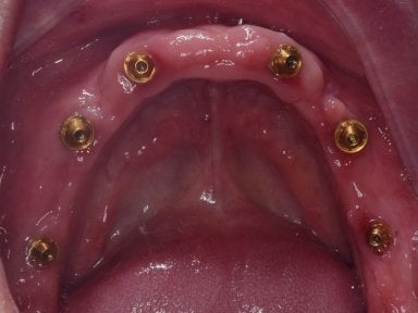 Dental implant placement result in upper jaw at Shanghai Y+bo Dental Clinic, oral surgery