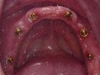 Dental implant placement result in upper jaw at Shanghai Y+bo Dental Clinic, oral surgery