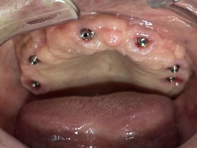 Dental implant placement result in upper jaw at Shanghai Y+bo Dental Clinic, visible abutments