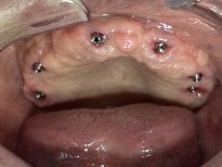 Dental implant placement result in upper jaw at Shanghai Y+bo Dental Clinic, visible abutments