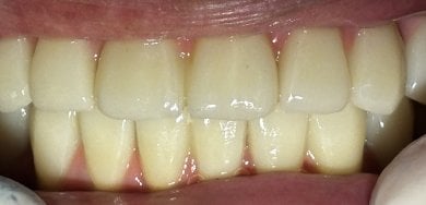 Dental implant result at Shanghai Y+bo Dental Clinic – restored natural-looking teeth