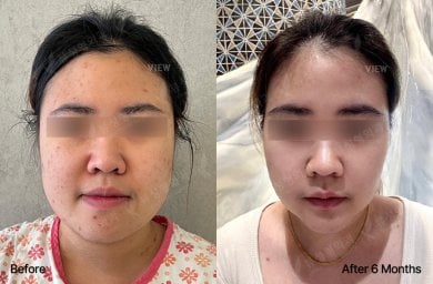 Before and after orthognathic surgery at View Plastic Surgery Hospital, 6 months result