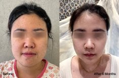Before and after orthognathic surgery at View Plastic Surgery Hospital, 6 months result