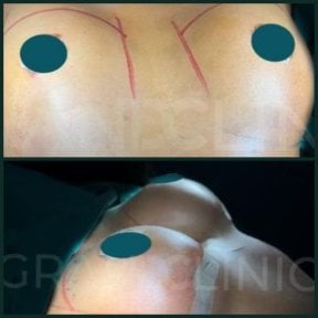 Efekty przed i po liftingu piersi w Grand Clinic, poprawa kształtu biustu