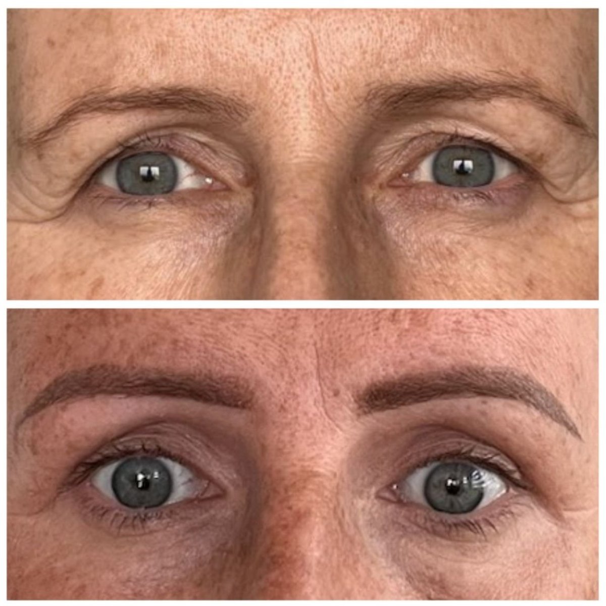 Resultados de cirugía de párpado superior antes y después en Radzikowska Clinic, ojos rejuvenecidos