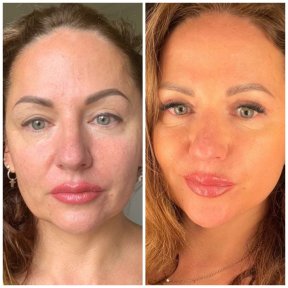 نتائج قبل وبعد شد الوجه العميق في Radzikowska Clinic، تجديد شباب الوجه