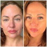 نتائج قبل وبعد شد الوجه العميق في Radzikowska Clinic، تجديد شباب الوجه