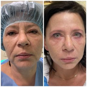 نتائج قبل وبعد شد الوجه العميق في Radzikowska Clinic، تجديد شباب الوجه
