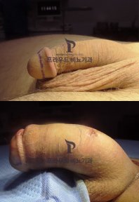 Результаты до и после увеличения пениса в Proud Urology Clinic – заметное увеличение объёма