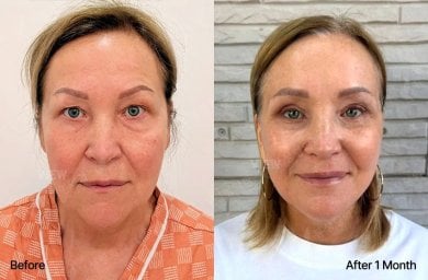 Результаты блефаропластики до и после в View Plastic Surgery Hospital, коррекция век