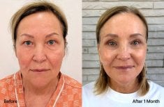 Результаты блефаропластики до и после в View Plastic Surgery Hospital, коррекция век