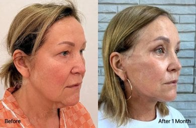 Результати блефаропластики до і після у View Plastic Surgery Hospital, корекція повік