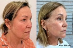 Результати блефаропластики до і після у View Plastic Surgery Hospital, корекція повік