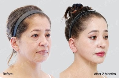 Результати блефаропластики до і після у View Plastic Surgery Hospital, корекція повік