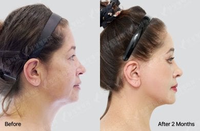 Результати підтяжки обличчя у View Plastic Surgery Hospital, покращення лінії підборіддя