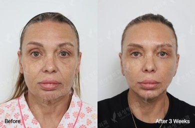 Блефаропластика до и после в View Plastic Surgery Hospital, результат коррекции век