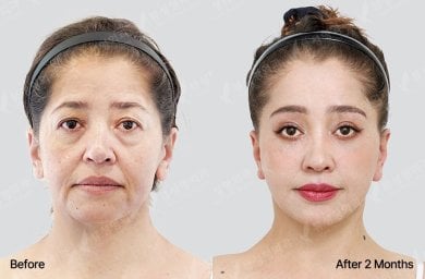 Результати блефаропластики до і після у View Plastic Surgery Hospital, корекція повік