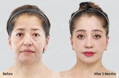 Результати блефаропластики до і після у View Plastic Surgery Hospital, корекція повік