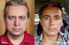 Блефаропластика до і після у View Plastic Surgery Hospital, результат корекції повік