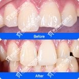 Before and after dental veneers at Shanghai Y+bo Dental Clinic, chipped tooth restoration result