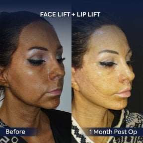 before-after photo podtazka-kozi-lica-fejslift