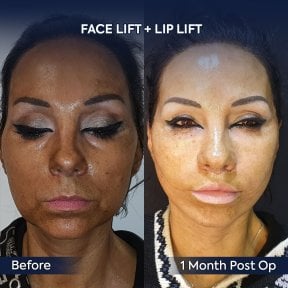 before-after photo podtazka-kozi-lica-fejslift