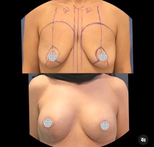 before-after photo breast-augmentation