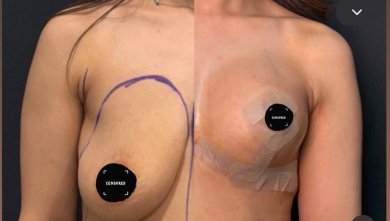 before-after photo breast-augmentation
