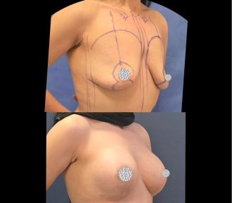 before-after photo breast-augmentation