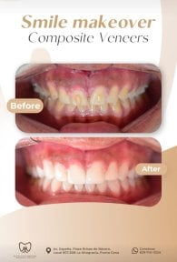 Efekt przed i po licówkach kompozytowych w Punta cana dentist odontologia familiar, uśmiech
