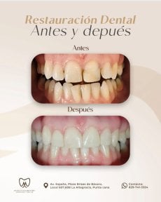 Efekty przed i po odbudowie zębów w Punta cana dentist odontologia familiar