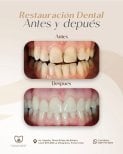 Efekty przed i po odbudowie zębów w Punta cana dentist odontologia familiar