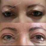 Résultats avant/après de la chirurgie des paupières à Lokman Hekim Istanbul Hospital