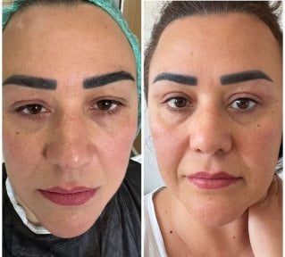 Résultats avant/après chirurgie des paupières supérieures et inférieures à Lokman Hekim Istanbul