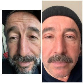 Résultats avant/après chirurgie des paupières supérieures et inférieures à Lokman Hekim Istanbul