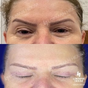 Résultats de la chirurgie des paupières supérieures et inférieures à Lokman Hekim Istanbul Hospital, rajeunissement du regard