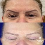Résultats de la chirurgie des paupières supérieures et inférieures à Lokman Hekim Istanbul Hospital, rajeunissement du regard