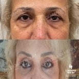Résultats avant/après chirurgie des paupières supérieures et inférieures à Lokman Hekim Istanbul