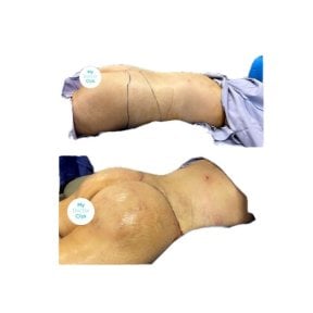 Resultados de liposucción antes y después en Hospital de la Familia, mejora del contorno corporal