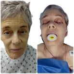 Resultados de minilifting facial antes y después en Hospital de la Familia, rejuvenecimiento facial