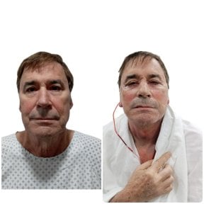 Resultados de minilifting facial antes y después en Hospital de la Familia, rejuvenecimiento facial