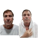 Resultados de minilifting facial antes y después en Hospital de la Familia, rejuvenecimiento facial