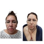 Resultados de minilifting facial antes y después en Hospital de la Familia, rejuvenecimiento facial