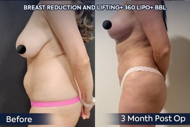 before-after photo brazilskaa-podtazka-agodic